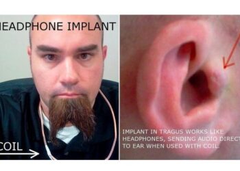 Άντρας εμφυτεύει ακουστικά στα αυτιά του!