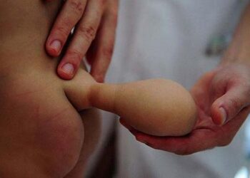 Απίστευτο: Γεννήθηκε μωρό με ουρά – Απεγνωσμένη η μητέρα του