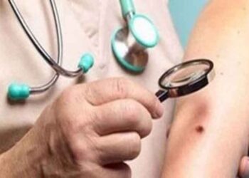 Πότε μια ελιά στο δέρμα του παιδιού γίνεται επικίνδυνη;