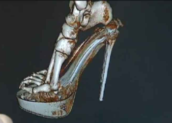 Ψηλά τακούνια;- Δείτε την τρισδιάστατη απεικόνιση της καταστροφής στα πόδια σας και ίσως το ξανασκεφτείτε [βίντεο]