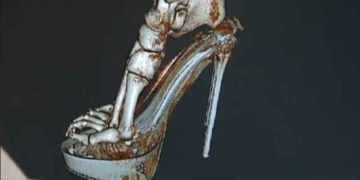 Ψηλά τακούνια;- Δείτε την τρισδιάστατη απεικόνιση της καταστροφής στα πόδια σας και ίσως το ξανασκεφτείτε [βίντεο]