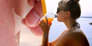 Αντιμετωπίστε δραστικά το ξεφλούδισμα από το κάψιμο