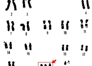 Πρώτο βήμα στην αντιμετώπιση του συνδρόμου Ντάουν;