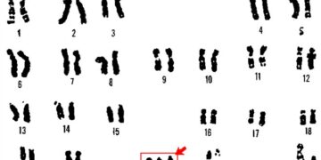 Πρώτο βήμα στην αντιμετώπιση του συνδρόμου Ντάουν;