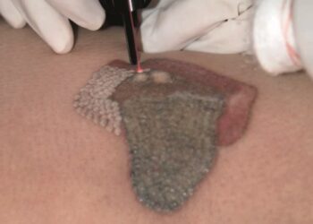 Μπορεί να αφαιρεθεί εντελώς ένα τατουάζ;