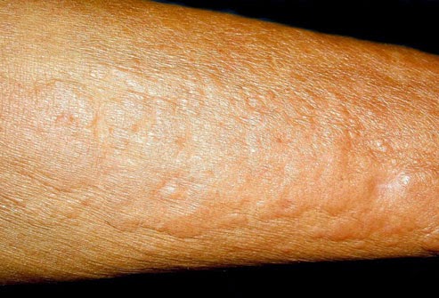 doj_photo_of_nephrogenic_systemic_fibrosis