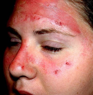 sunburn-2