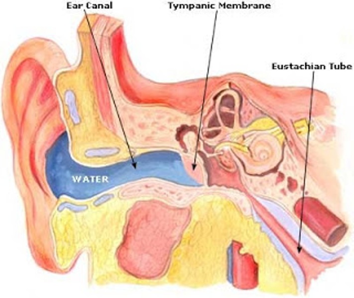 swimmers-ear-picture