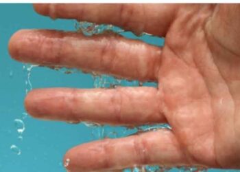 Παλάμες που ιδρώνουν: Πώς θα απαλλαγείτε με φυσικό τρόπο