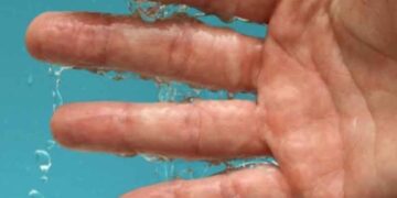 Παλάμες που ιδρώνουν: Πώς θα απαλλαγείτε με φυσικό τρόπο