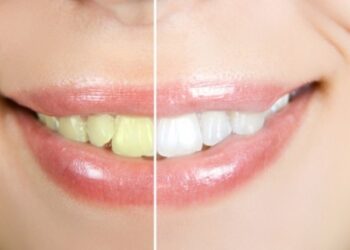 Τέσσερις φυσικοί τρόποι για πιο λευκά δόντια