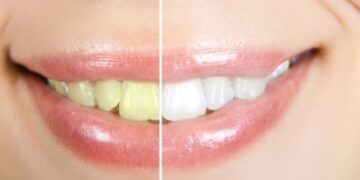 Τέσσερις φυσικοί τρόποι για πιο λευκά δόντια