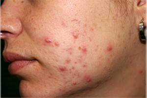dermnet_rf_photo_of_moderate_acne_on_womans_cheek
