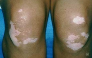 vitiligo_knees