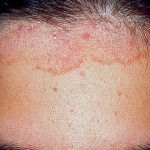 seboreen-dermatit-kosopad