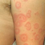 erythema-multiforme-pictures-4