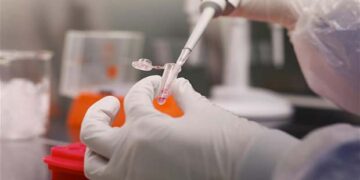 Νέα πρωτοποριακή θεραπεία αντιμετώπισης της αρθρίτιδας του αντίχειρα