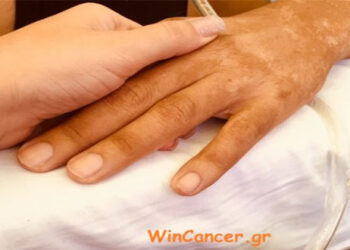 Καρκίνος … πώς μπορώ να βοηθήσω τον άνθρωπο που νοσεί – Γράφει η Θεοπίστη Κρυσταλλίδου