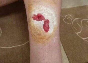 Πτολεμαΐδα: Καταγγελία πολίτη για επίθεση από αδέσποτο σκύλο – Κατέληξε στο νοσοκομείο για τις πρώτες βοήθειες