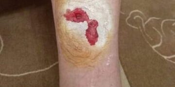 Πτολεμαΐδα: Καταγγελία πολίτη για επίθεση από αδέσποτο σκύλο – Κατέληξε στο νοσοκομείο για τις πρώτες βοήθειες