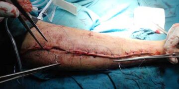 Απατεώνες οργώνουν ξανά την Πτολεμαΐδα και την Εορδαία – Ζητούν υπέρογκα ποσά για δήθεν επείγοντα χειρουργεία