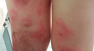 Προσοχή στις συνθήκες υγιεινής στις παιδικές κατασκηνώσεις λόγω μολυσματικών δερματοπαθειών – Γράφει ο Μάκης Μοκάσαμπι, Παιδίατρος