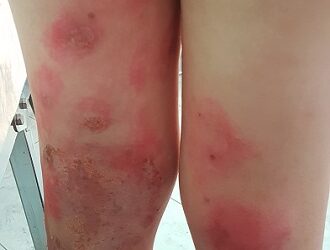 Προσοχή στις συνθήκες υγιεινής στις παιδικές κατασκηνώσεις λόγω μολυσματικών δερματοπαθειών – Γράφει ο Μάκης Μοκάσαμπι, Παιδίατρος