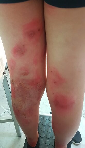 Προσοχή στις συνθήκες υγιεινής στις παιδικές κατασκηνώσεις λόγω μολυσματικών δερματοπαθειών – Γράφει ο Μάκης Μοκάσαμπι, Παιδίατρος