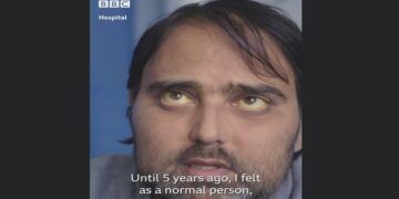 Η συγκινητική ιστορία ζωής του ψυχιάτρου Τριαντάφυλλου Τριανταφυλλίδη που λόγω σπάνιας πάθησης χρειάστηκε και έκανε μεταμόσχευσης ήπατος, βγαίνοντας νικητής – Η ιστορία του έγινε Ρεπορτάζ στο BBC (video)