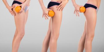 Αντιμετώπιση κυτταρίτιδας από τα ινστιτούτα αισθητικής στην Αγία Παρασκευή