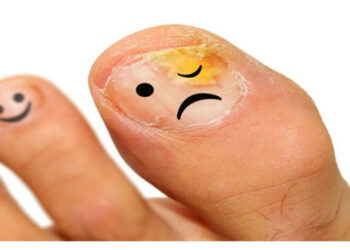 Μύκητες Νυχιών (Ονυχομυκητίαση) | Πώς Θα τους Καταπολεμήσω;