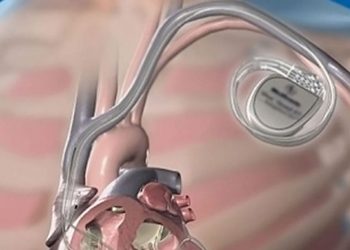 Τι είναι βηματοδότης- Γράφει ο Ιορδάνης Καμπουρίδης