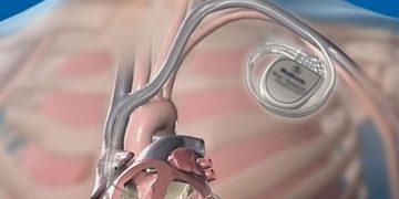 Τι είναι βηματοδότης- Γράφει ο Ιορδάνης Καμπουρίδης