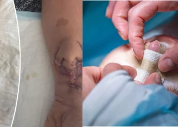 Μεγάλωνε μόσχευμα μύτης πάνω στο χέρι της- Της πήρε δυο μήνες για την μεταμόσχευση