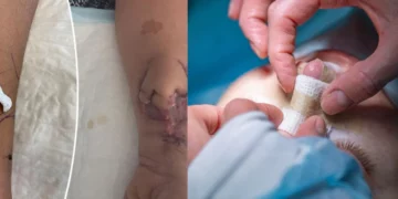 Μεγάλωνε μόσχευμα μύτης πάνω στο χέρι της- Της πήρε δυο μήνες για την μεταμόσχευση