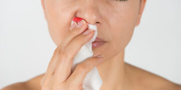Γιατί ματώνει η μύτη; Τι να κάνετε στη ρινορραγία, επίσταξη για να σταματήσει να τρέχει αίμα; (video)