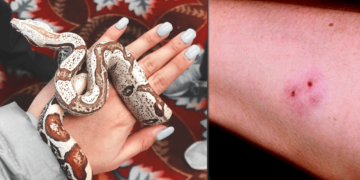 "Με τσίμπησε φίδι, τι να κάνω;" - Δάγκωμα φιδιού: τι να κάνετε και τι να μην κάνετε