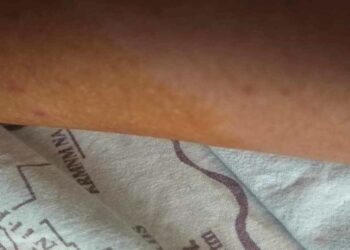 Όλα καλά με τον 13χρονο από την Ασβεστόπετρα που τον δάγκωσε  φίδι την Παρασκευή