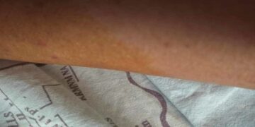 Όλα καλά με τον 13χρονο από την Ασβεστόπετρα που τον δάγκωσε  φίδι την Παρασκευή