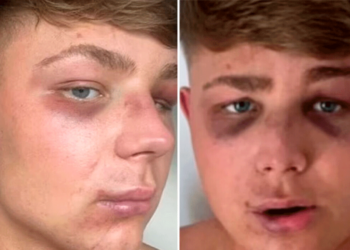 «Με έστειλαν στο νοσοκομείο για μία selfie», λέει ο Βρετανός τουρίστας που ξυλοκοπήθηκε από μπράβους στη Ζάκυνθο