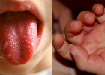 ΕΟΔΥ: 41 παιδιά με κοξάκι μόνο στη Λάρισα – Τι συνιστούν οι ειδικοί στους γονείς