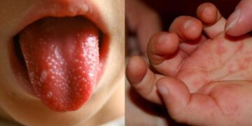 ΕΟΔΥ: 41 παιδιά με κοξάκι μόνο στη Λάρισα – Τι συνιστούν οι ειδικοί στους γονείς