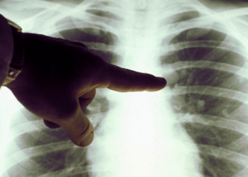 Κάθε πότε πρέπει να εξετάζεται για καρκίνο του πνεύμονα ένας καπνιστής