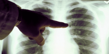 Κάθε πότε πρέπει να εξετάζεται για καρκίνο του πνεύμονα ένας καπνιστής