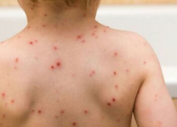 Ιλαρά: Συναγερμός μετά τα 5 επιβεβαιωμένα κρούσματα – Τι θα πρέπει να προσέχουν οι ταξιδιώτες στο εξωτερικό