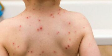 Ιλαρά: Συναγερμός μετά τα 5 επιβεβαιωμένα κρούσματα – Τι θα πρέπει να προσέχουν οι ταξιδιώτες στο εξωτερικό