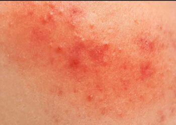 Κοκκινίλες στο σώμα με ή χωρίς φαγούρα. Προσοχή στον έντονο και παρατεταμένο κνησμό