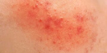 Κοκκινίλες στο σώμα με ή χωρίς φαγούρα. Προσοχή στον έντονο και παρατεταμένο κνησμό