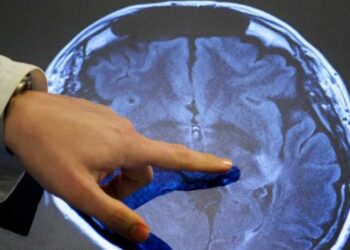 Έρευνα συνδέει την κλιματική αλλαγή με την αύξηση των εγκεφαλικών επεισοδίων