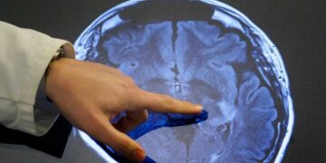 Έρευνα συνδέει την κλιματική αλλαγή με την αύξηση των εγκεφαλικών επεισοδίων